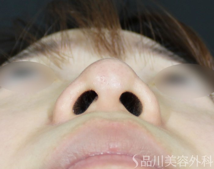症例NO.65045のBEFORE写真