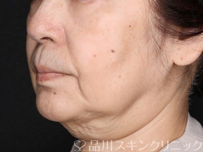 症例NO.72891のBEFORE写真