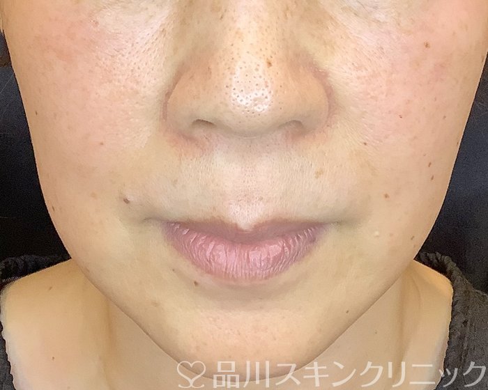 症例NO.67027のBEFORE写真