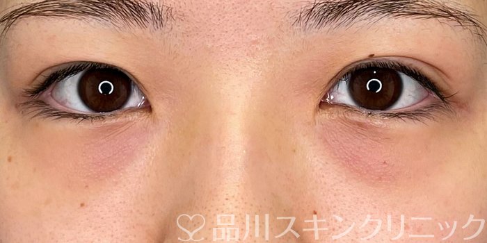 症例NO.69726のBEFORE写真