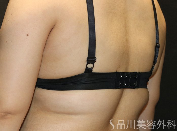 症例NO.74609のBEFORE写真