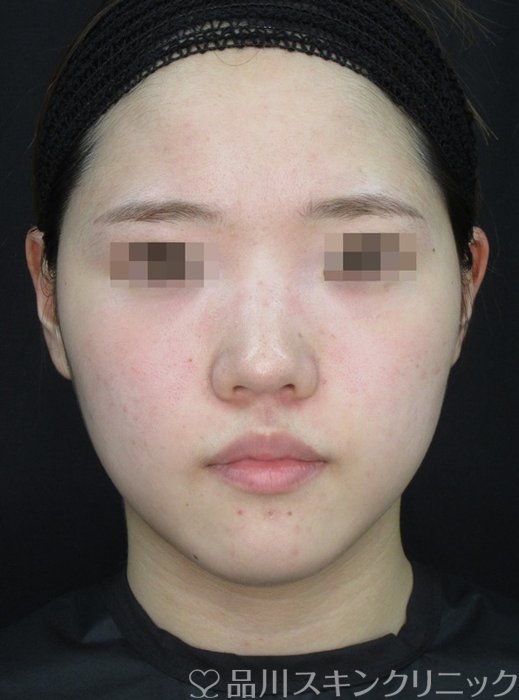 症例NO.72137のAFTER写真