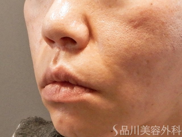 症例NO.69213のBEFORE写真
