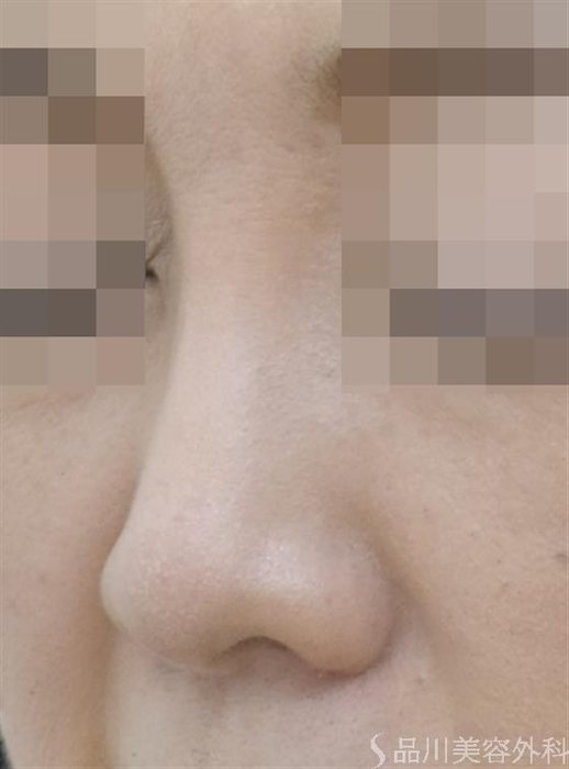 症例NO.46181のAFTER写真