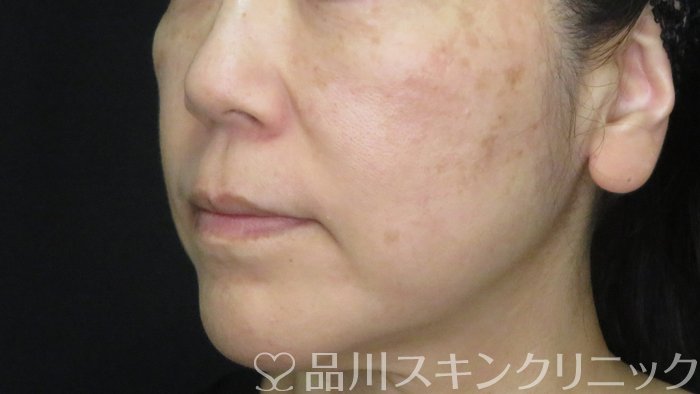 症例NO.71922のBEFORE写真