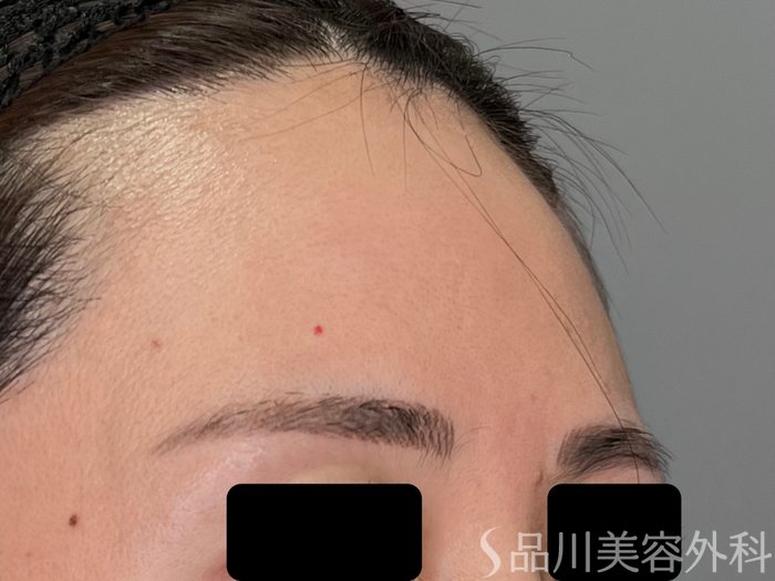 症例NO.70912のBEFORE写真
