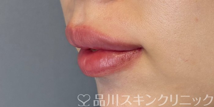 症例NO.71732のAFTER写真