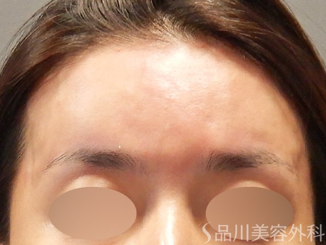 症例NO.71727のAFTER写真