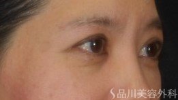 症例NO.72523のAFTER写真