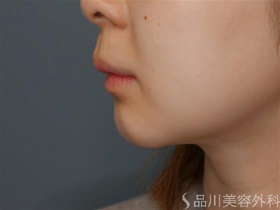 症例NO.59069のBEFORE写真