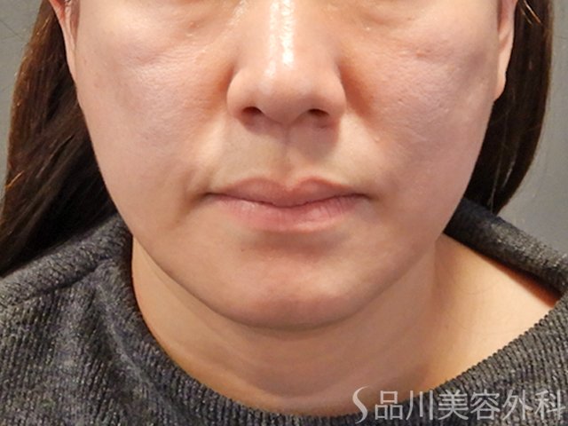 症例NO.75065のAFTER写真