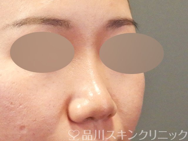 症例NO.64721のAFTER写真