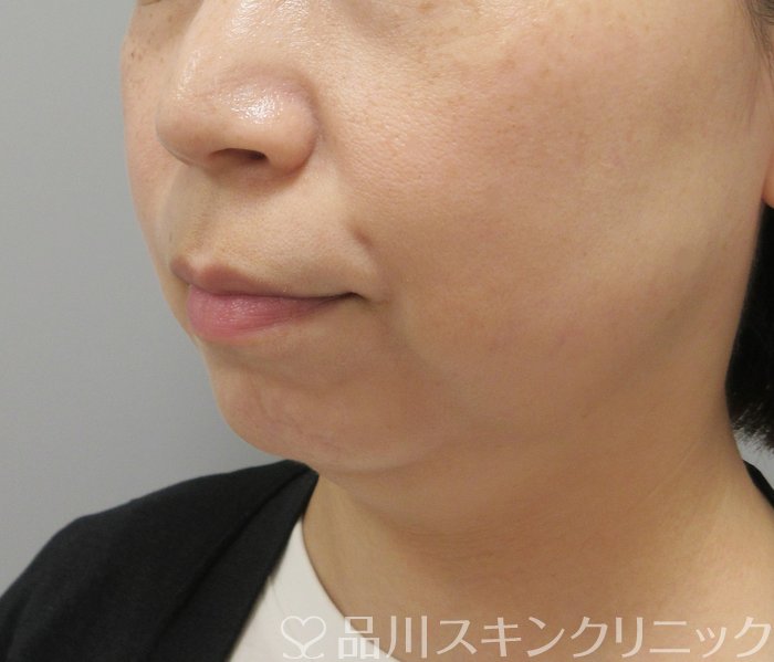 症例NO.70413のBEFORE写真