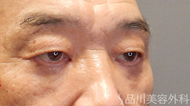 症例NO.75223のAFTER写真