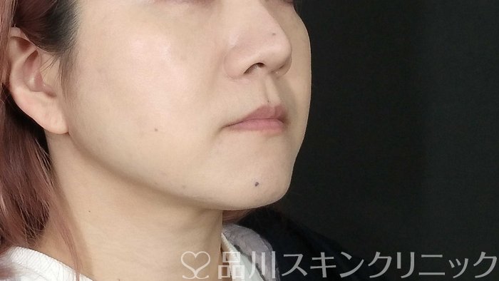 症例NO.72998のAFTER写真