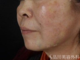 症例NO.73530のAFTER写真