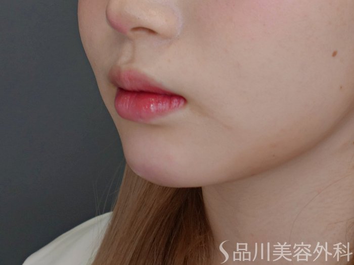 症例NO.71716のAFTER写真