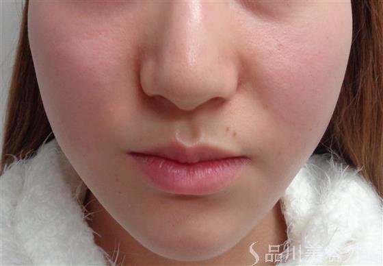 症例NO.47042のAFTER写真