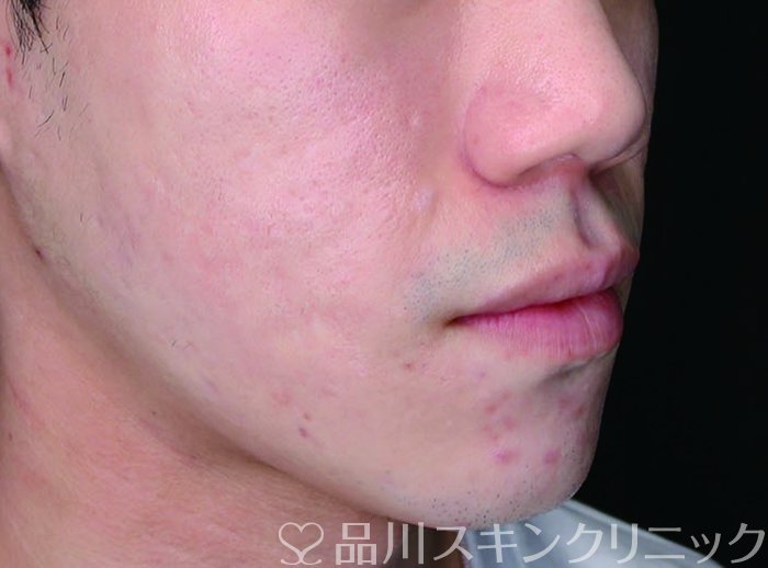 症例NO.73167のAFTER写真