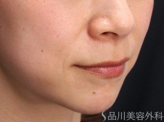 症例NO.69674のBEFORE写真