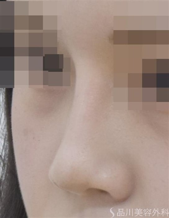 症例NO.47631のAFTER写真