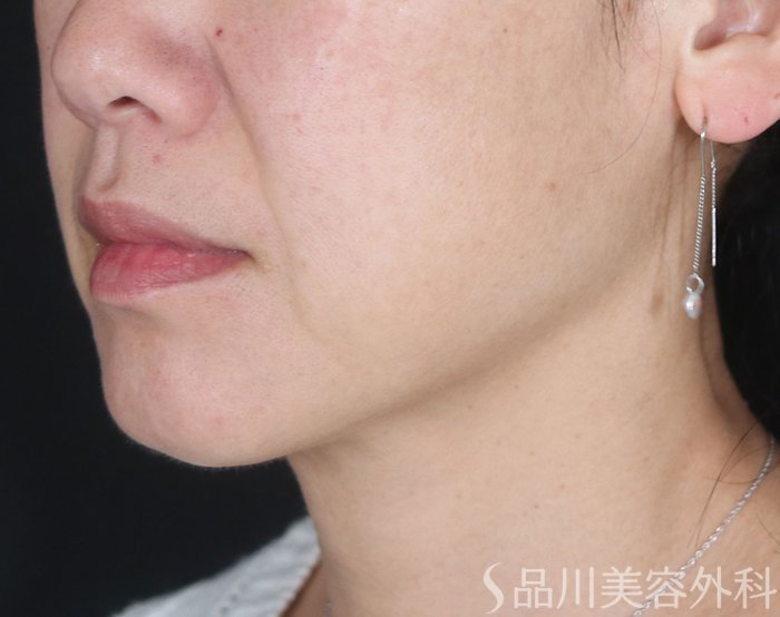 症例NO.73569のBEFORE写真