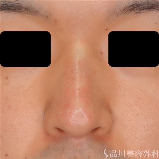 症例NO.53702のAFTER写真