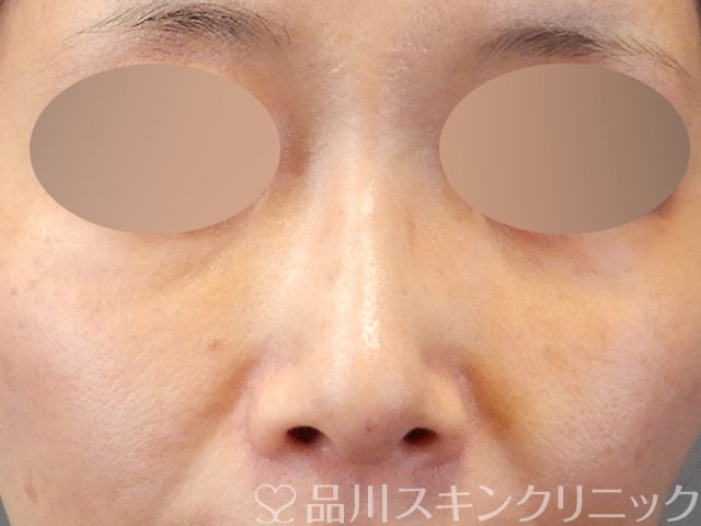 症例NO.67536のAFTER写真