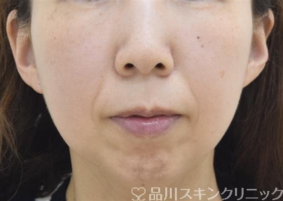 症例NO.43230のBEFORE写真