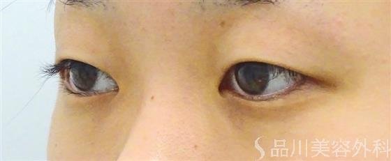 症例NO.47140のBEFORE写真