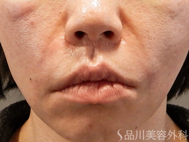 症例NO.69213のAFTER写真