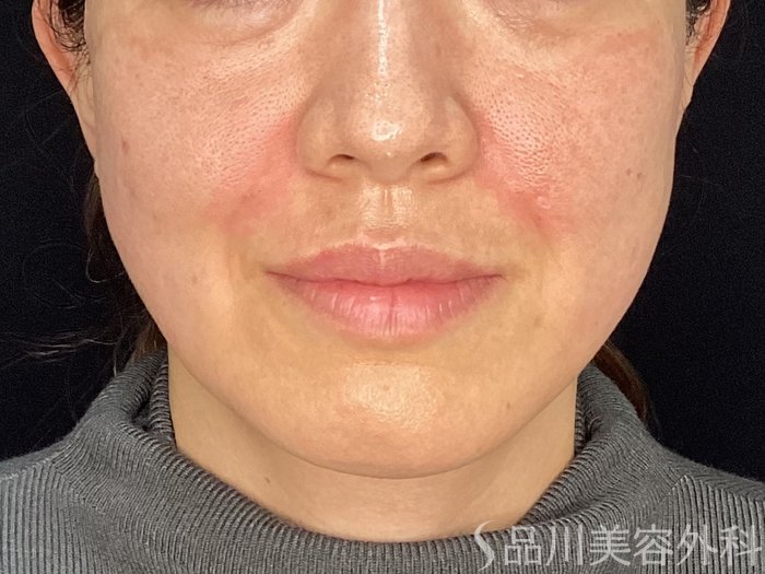 症例NO.71995のAFTER写真