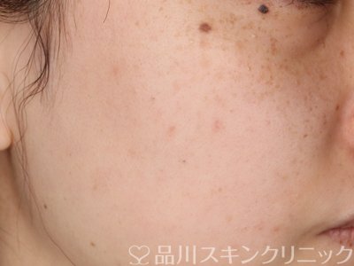 症例NO.68676のAFTER写真