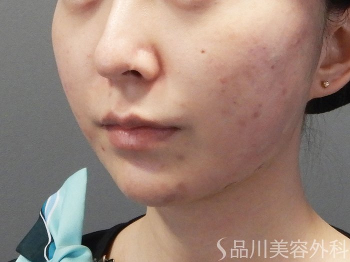 症例NO.72591のAFTER写真