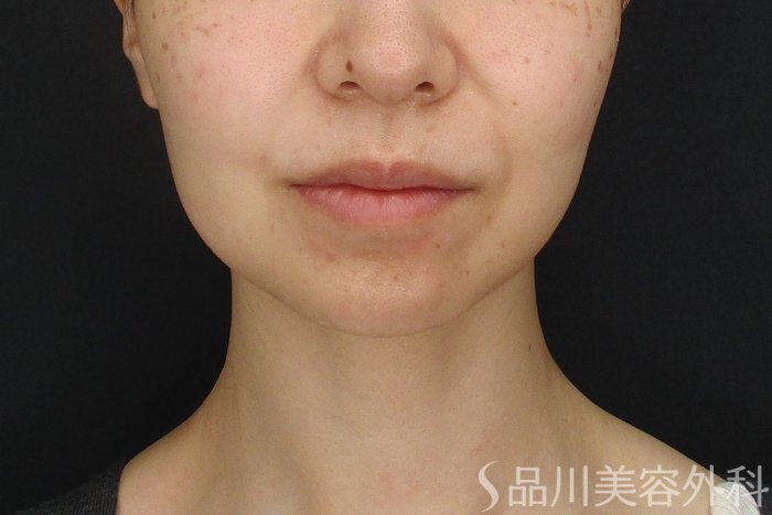 症例NO.71079のBEFORE写真
