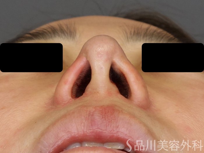 症例NO.72350のAFTER写真