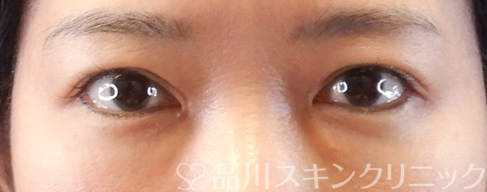 症例NO.63407のAFTER写真