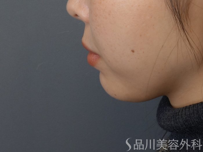 症例NO.72601のBEFORE写真