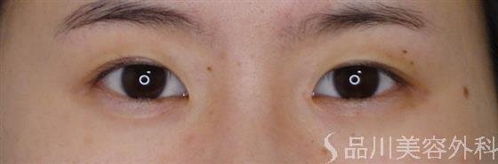 症例NO.52151のBEFORE写真