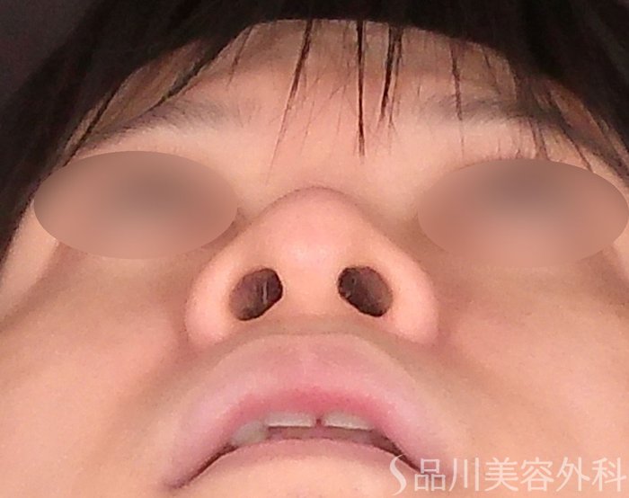 症例NO.70649のAFTER写真