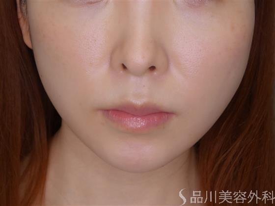 症例NO.52938のBEFORE写真