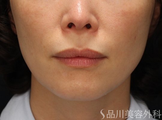 症例NO.73348のBEFORE写真