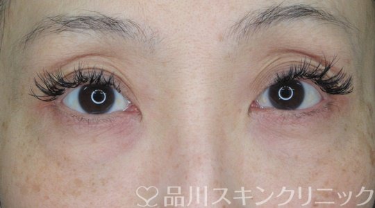 症例NO.69633のBEFORE写真