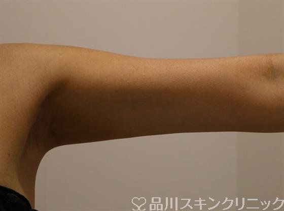 症例NO.42996のAFTER写真