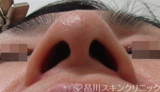 症例NO.29914のAFTER写真
