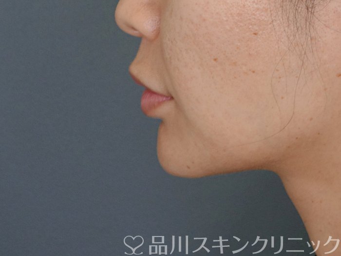 症例NO.72435のBEFORE写真