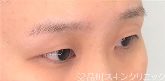 症例NO.52787のBEFORE写真