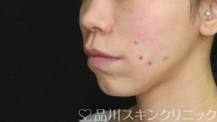 症例NO.72953のAFTER写真