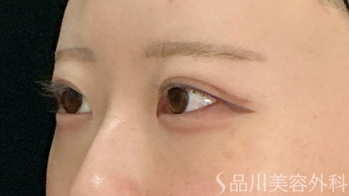 症例NO.71761のAFTER写真