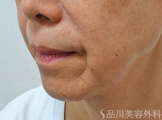 症例NO.73520のBEFORE写真